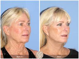 Natural Facelift
