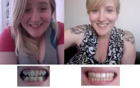 $300 off for a limited time; 15 Drastic Transformations Of People Before And After Braces