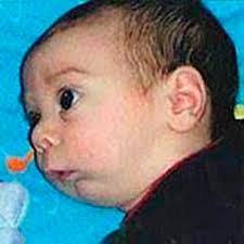 Síndrome Pierre Robin o Secuencia Pierre Robin