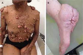 Tumorigenesis In Neurofibromatosis Type 1: Role Of The Microenvironment |  Oncogene