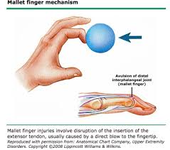 Image result for Elson Extensor Tendon Test