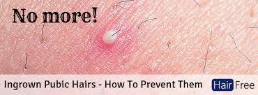Doing so will have to include unclogging the blocked skin and make the hair straighten in order to grow out the skin. Ingrown Pubic Hairs What To Do And How To Prevent Them From Coming Back Hair Free Life