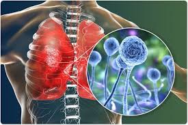 Se presentan 5 pacientes con mucormicosis con diferentes formas clínicas de presentación. Tratamiento De La Mucormicosis