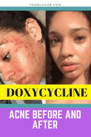 Doxycycline For Acne Before And After Acnetreatment Getridofacnefast Acnetreatmenttips Acnepills How To Get Rid Of Acne Teenage Acne Acne