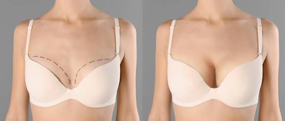 Breast augmentation in Tunisia &ndash; Natural results guaranteed