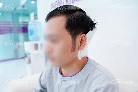 Cấy tóc mai tự thân giúp tạo đường viền tóc mai rõ nét và ấn tượng