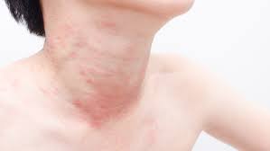 Unusual Flu Symptoms Are Hives A Symptom Of The Flu