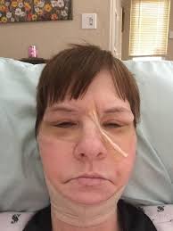 Hiking mountains in New Hampshire after surgery