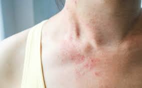 Sonnenallergie Polymorphe Lichtdermatose Wie Kann Man Vorbeugen Was Hilft Gegen Akute Symptome Onmeda De