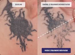 During a laser tattoo removal treatment, the laser's high energy light breaks up the tattoo ink into tiny particles, which are gradually absorbed by the skin. Shorten Your Tattoo Removal Duration With The New Pfd Patch Vanish Laser Clinic Alexandria Va