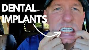 What No One Told Me Before Getting Dental Implant Surgery 🦷🤯,
