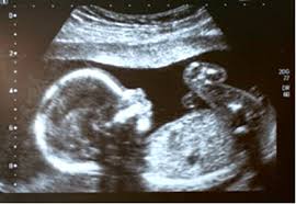 La ecografía a través del uso de ondas de ultrasonido permite generar imágenes general de los órganos y la estructural fetal, permite estudiar el crecimiento y bienestar del bebé. Ecografia Piece Semanas De Impedimento 22 Semanas De Embarazo Ecografia Morfologica