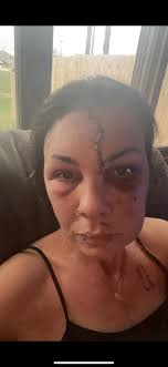 Man falls off ladder and gets 100 stitches