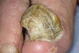 Image result for Onychogryphosis feet