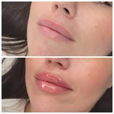 Hi all! My name is Amy Gensale, NP-C, and I own Goddess Aesthetics Medspa  in Dracut, Ma. I offer botox, dermal fillers, Diamond Glow facials, weight  loss injections, microneedling, chemical peels, Kybella,