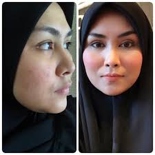 Menghilangkan jerawat dan parut jerawat dengan berkesan. Mudahnya Hilangkan Kesan Parut Jerawat Wanita Ini Tak Lokek Kongsi 6 Produk Paling Berkesan Digunakan Hijabista