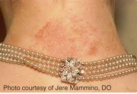 Fact Sheet 1 Nickel Allergic Contact Dermatitis Nickel Institute