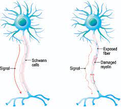 This damage disrupts the ability of parts of the nervous system to transmit signals, resulting in a range of signs and symptoms, including physical, mental, and sometimes psychiatric problems. Multiple Sclerosis Ms Symptoms Progression Diagnosis Etc Stiwell