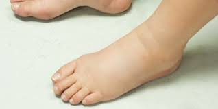 Kaki bengkak merupakan keadaan yang mungkin selalu dialami oleh sesetengah individu terutamanya wanita yang sedang mengandung. 10 Cara Mengatasi Kaki Bengkak Saat Hamil Perhatikan Konsumsi Harian Merdeka Com