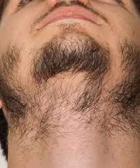 Don't allow one patch or two or three to dictate. 12 Best Beard Patches Ideas Beard Beard Patches Handlebar Mustache