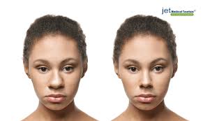 Find quick results from multiple sources. Wide Nose Rhinoplasty Everything You Need To Know