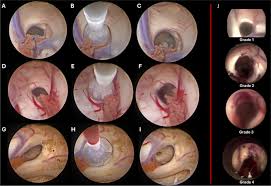 Neuroendoscopic access to the third ventricle in patients with narrow  foramen of monro without stenosis/obstruction: role of foraminoplasty