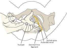Image result for Intrapleural Anesthesia
