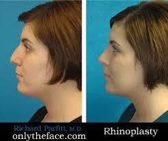 Rhinoplasty Before and After Photos