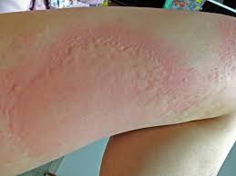 Check spelling or type a new query. Is It A Hepatitis C Rash