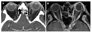 Orbital Inflammatory Disease Pictorial Review And Differential Diagnosis