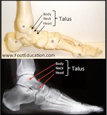 Image result for Talus Fracture