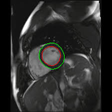 Image result for Nuclear Ventriculogram