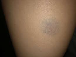 Ist ein bein wärmer als das andere, weist das zusätzlich auf eine thrombose hin. Hier Thrombose Moglich Gesundheit Medizin