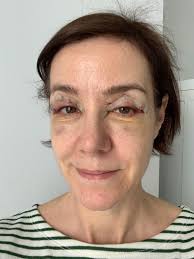 Die wahrscheinlichkeit einer komplikation ist bei einer lidstraffung sehr gering. Lidstraffung Blepharoplastik Augenlidkorrektur Schlupflid Lid Op