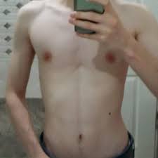 Pectus Excavatum Kunduraci Gogsu Fotograf Eklendi Ameliyat Oldum