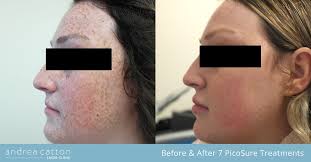 Freckles are tiny brown spots that can appear on the skin due to many factors. Laser Freckle Removal Uk Picosure Fla Revlite Andrea Catton Laser Clinic