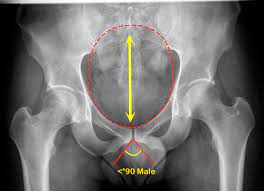 What is the collateral circulation after hypogastric artery ligation? Pelvis Series Radiology Reference Article Radiopaedia Org