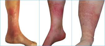 Kompressionsstrumpfe Bei Stauungsdermatitis Schone Beine