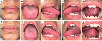 Image result for Lip Exam