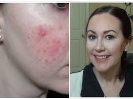 Foundation Routine *Rosacea, Extreme Redness, Acne*