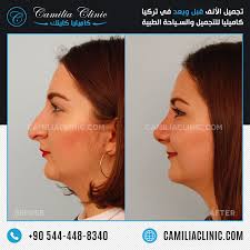 Nose Reshaping Rhinoplasty Istanbul Turkey Nose Reshaping Rhinoplasty Plastic Surgery