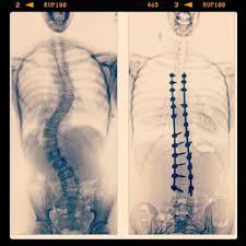 My Friend Before And After Her Spinal Fusion Spinal Fusion Scoliosis Spinal Surgery