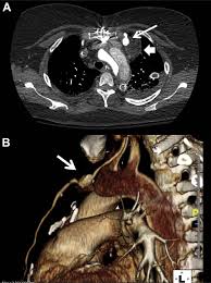 We did not find results for: Endovascular Repair Of An Internal Mammary Artery Aneurysm In A Patient With Smad 3 Mutation Journal Of Vascular Surgery