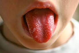 We did not find results for: Scarlattina Cause Contagio Sintomi Diagnosi Cura E Complicazioni