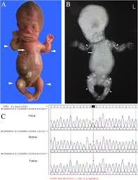 Yet this is the truth…people need to see this…abortion is hideous and torture to a c child! Prenatal Diagnosis Of Fetal Skeletal Dysplasia Using Targeted Next Generation Sequencing An Analysis Of 30 Cases Diagnostic Pathology Full Text