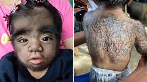 Image result for Hypertrichosis