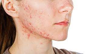This article will discuss causes of nodular acne, and ways to treat and. How To Identify And Treat Nodular Acne Skinkraft