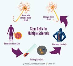 The goal of treatment is to help you cope with and relieve symptoms, slow the progress of the disease and maintain a good quality of life. Multiple Sclerosis Stem Cell Therapy In Mexico Safe Legal And Quality