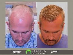 Maybe you would like to learn more about one of these? Top Fue Only Hair Transplant Surgeon Charlotte Nc Charleston Sc