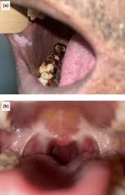 Image result for Erythroplakia roof of mouth